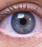 טיפות סטרואידים לעיניים - תמונת המחשה